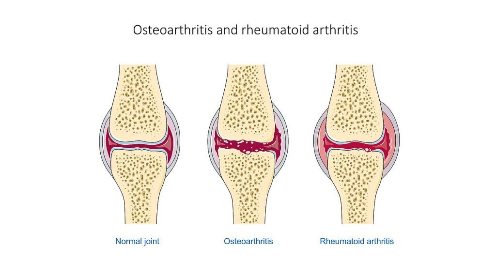 Arthritis pain