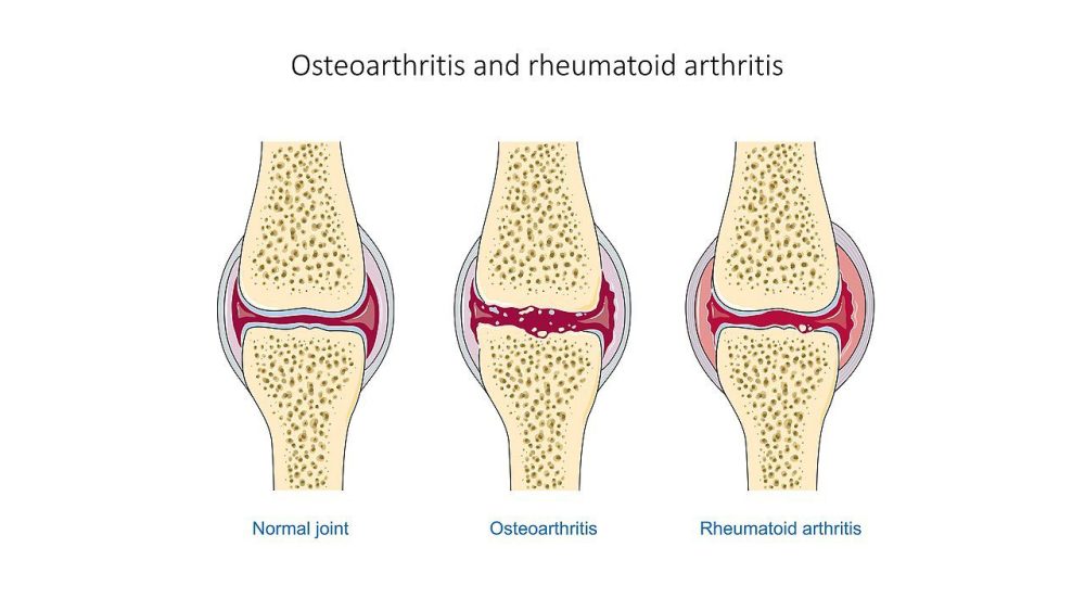 Arthritis pain