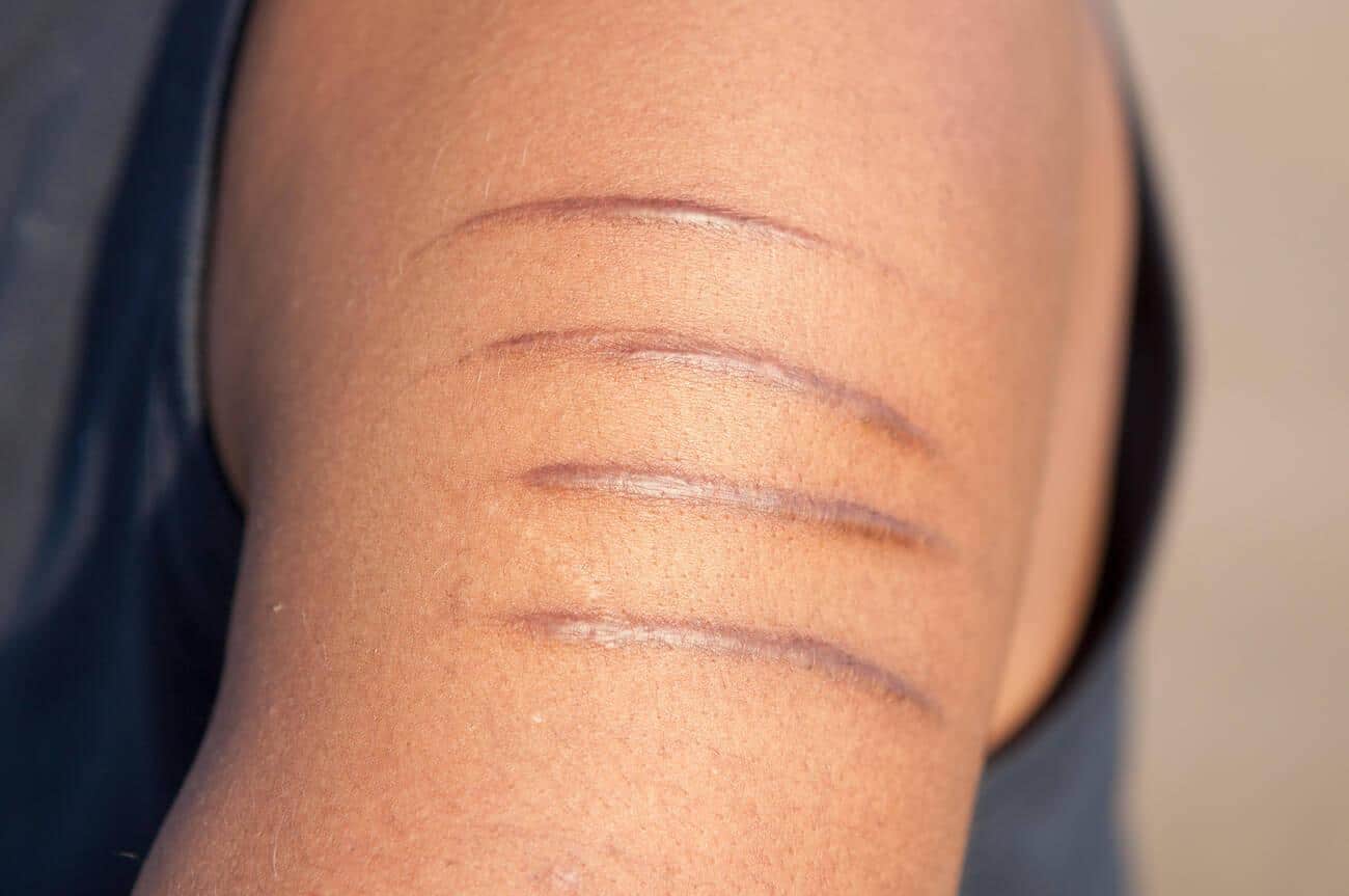 scar shapes