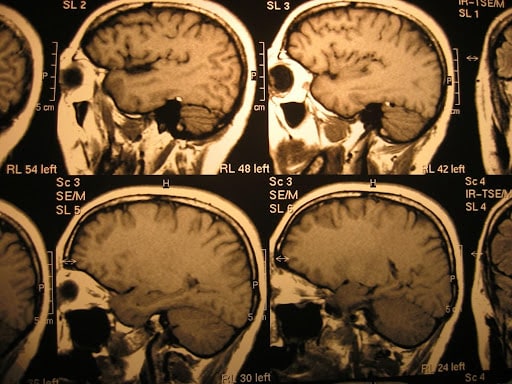 What are the causes and symptoms of traumatic brain injury