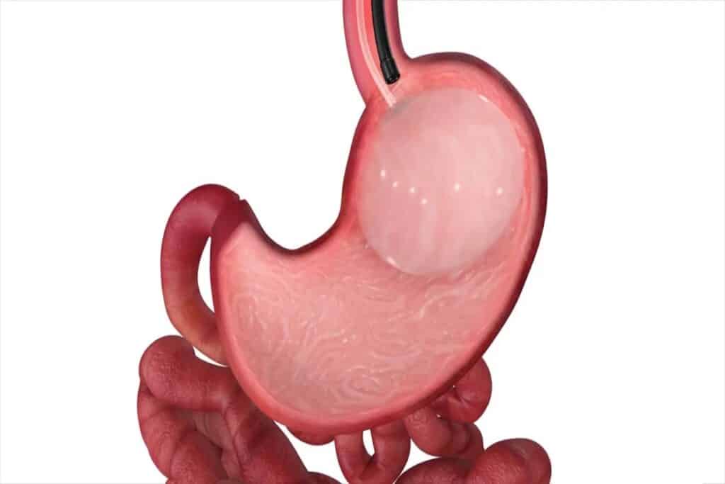 Weight Loss Balloon