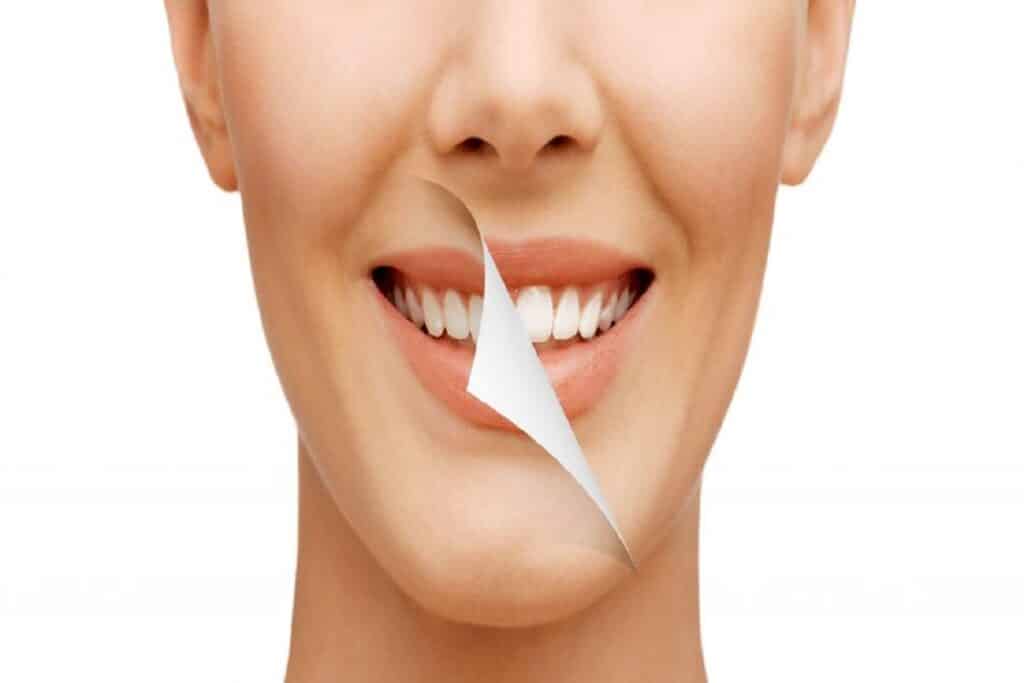Smile Makeover Treatments