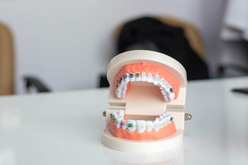 Underbite