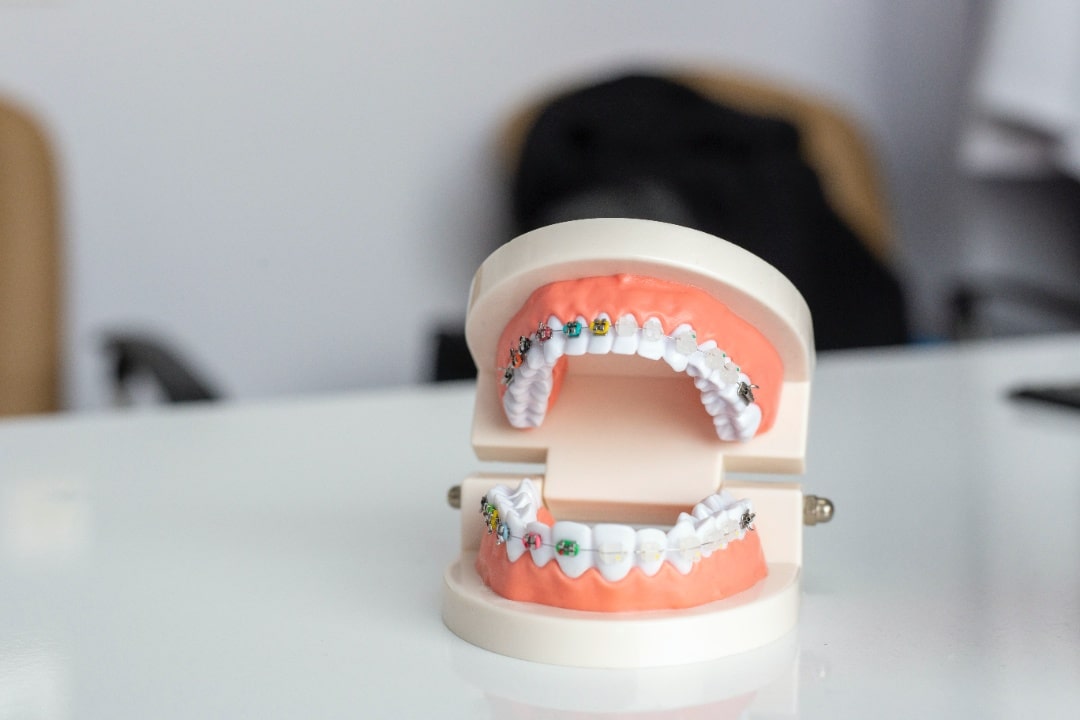 Underbite