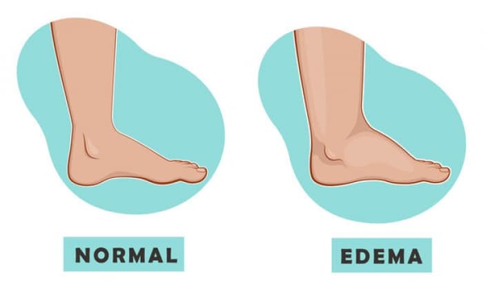swollen foot after knee surgery