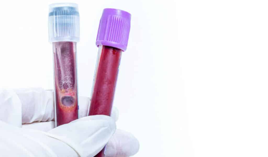 AI-based Blood Test to Detect Cancer