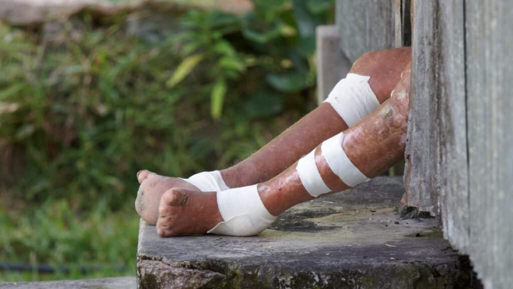 Leprosy in Florida