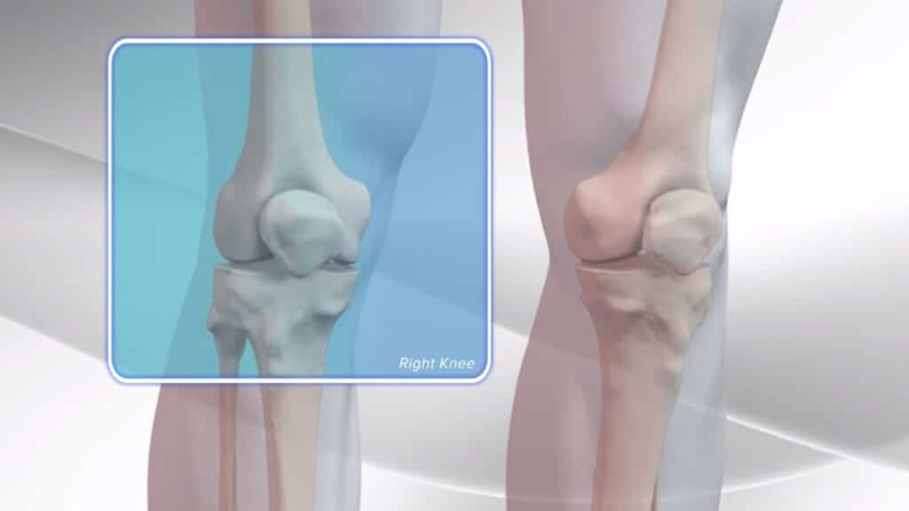 Knee Replacement Surgery Recovery Tips