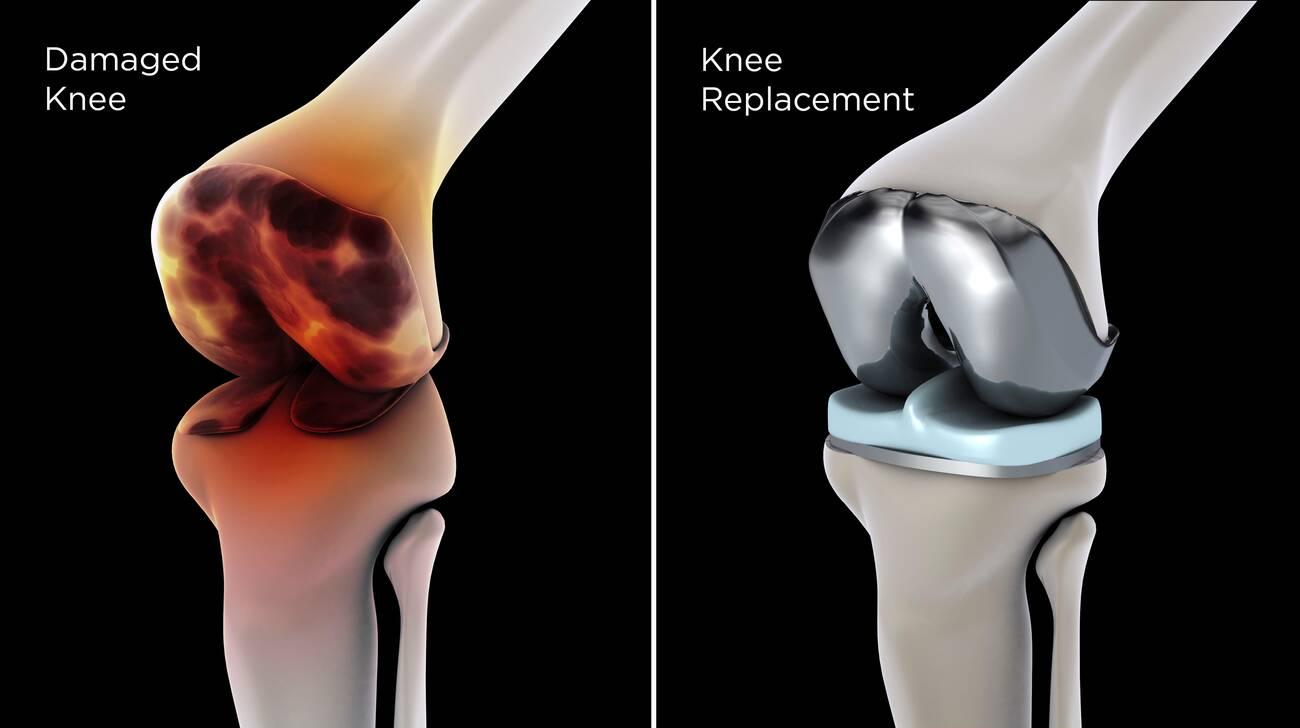 knee replacement