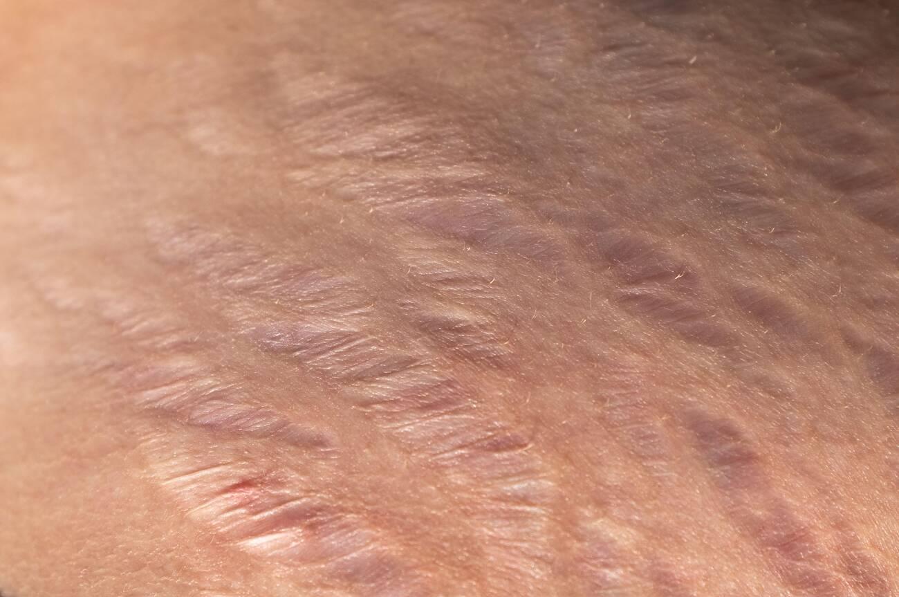 stretch marks