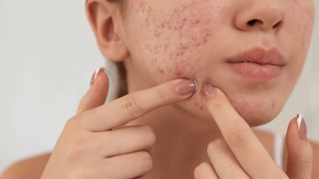 Understanding How Scar Creams Work