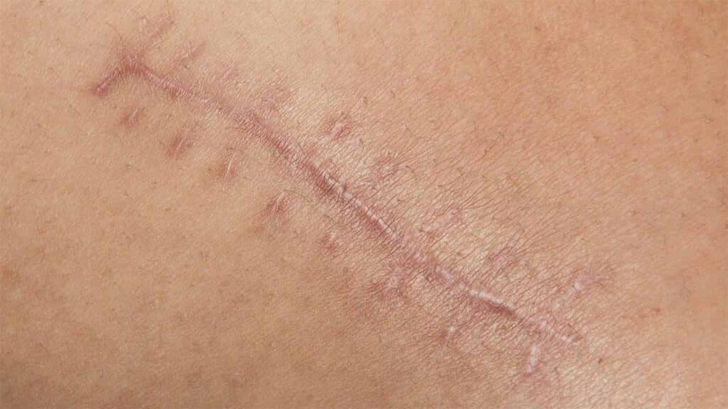 Close-up of a healing surgical scar.
