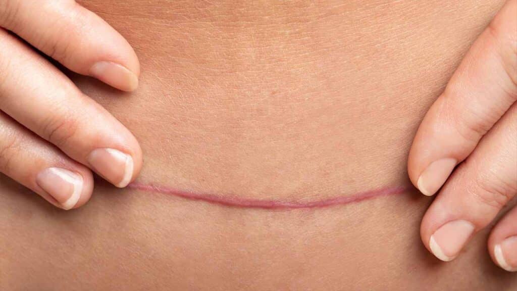 Close-up of hands touching a healing scar.