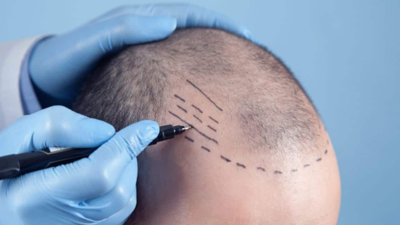 Advice to Meet the Best Hair Transplant Clinic in Turkey